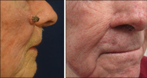 facelift